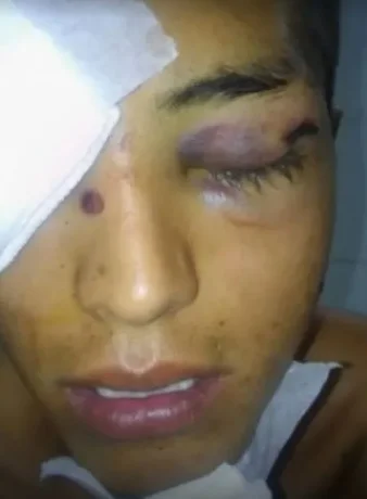 Luciano Cruz perdió un ojo, y por eso 4 policías podrían ser enjuiciados